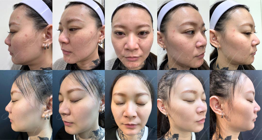 Dermapen 療程效果圖